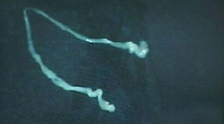 Chengdu Man Has 15cm Worm Removed from His Brain