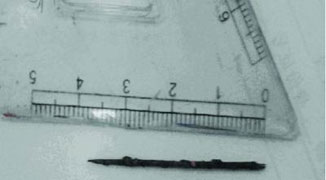 Woman Gets Embroidery Needle Removed from Uterus After 20 Years