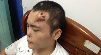 Crash Victim Follows Doctor’s Orders and Grows Nose on Forehead